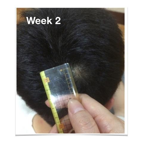 Miracle Hair Regain Treatment Regrowth Serum Against Hair Loss