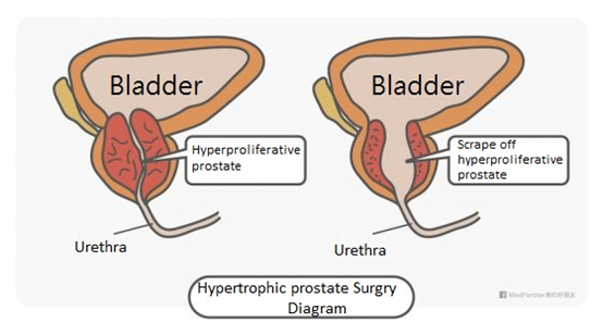 Hypertrophic prostate surgery diagram
