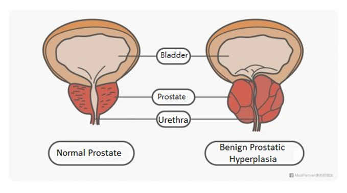 normal prostate compare with (benign prostatic hyperplasia)
                     BPH