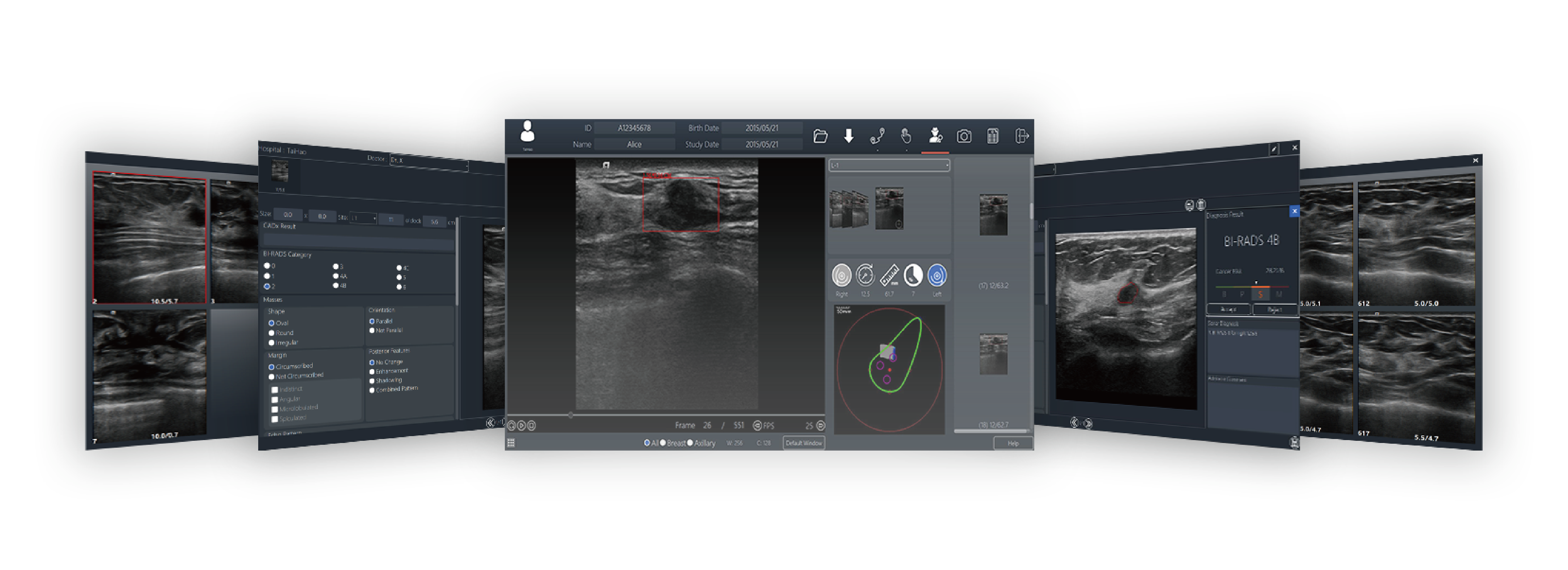 Ultrasound Breast Cancer Computer Aided Diagnosis Decision Support System